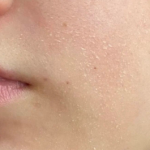 dry skin