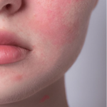 sensitive skin